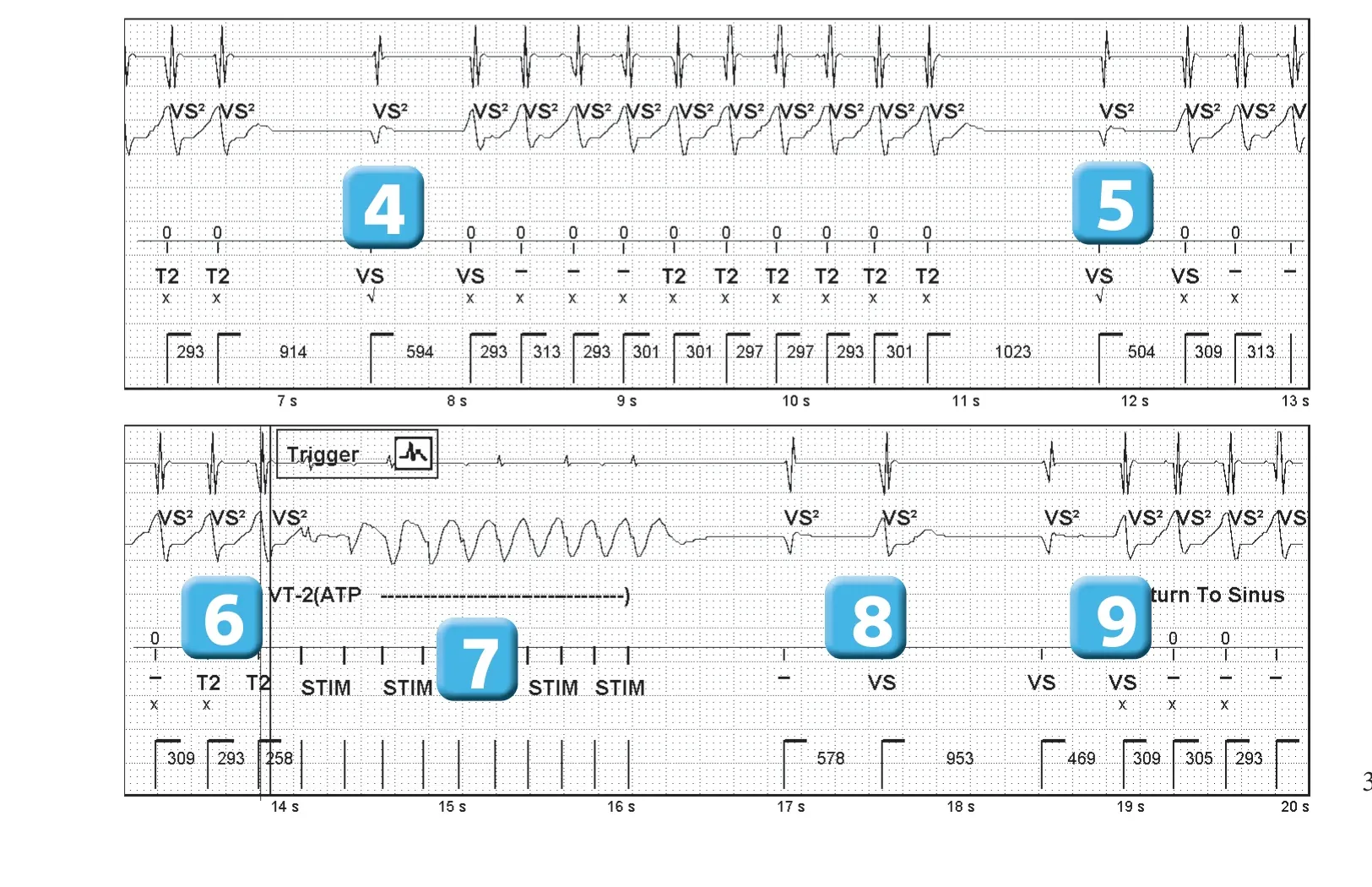 Abbott ICD electrogram, segment 2 of 2 — Sinus return counter and non-sustained ventricular tachycardias