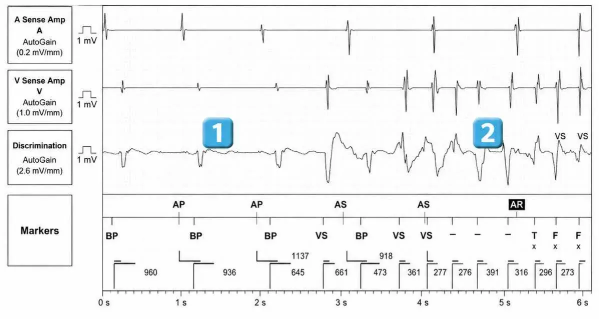 Abbott ICD electrogram, segment 1 of 6 — Redetection counter after acceleration of VT in the VF zone