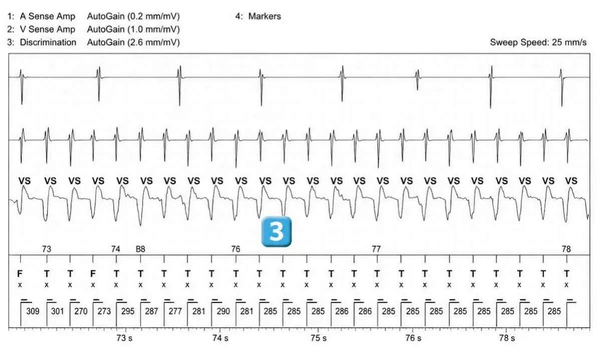 Abbott ICD electrogram, segment 2 of 6 — Redetection counter after acceleration of VT in the VF zone