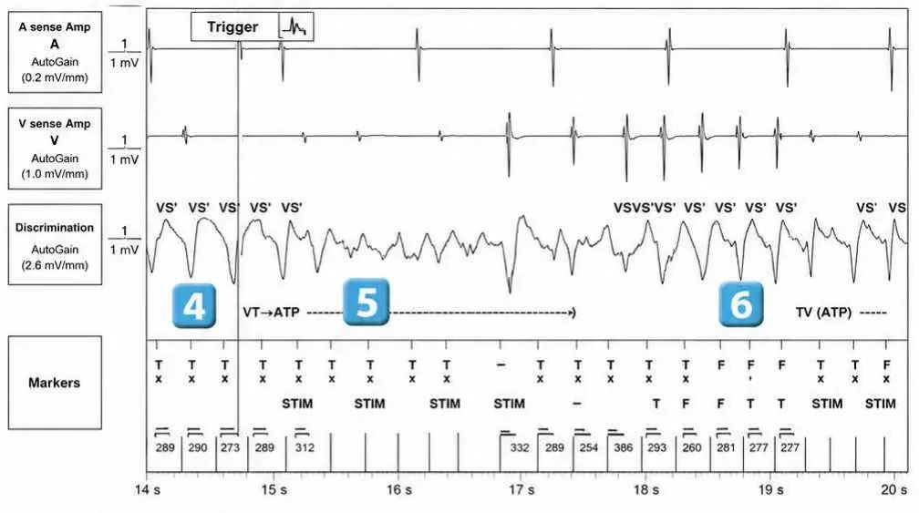Abbott ICD electrogram, segment 3 of 6 — Redetection counter after acceleration of VT in the VF zone