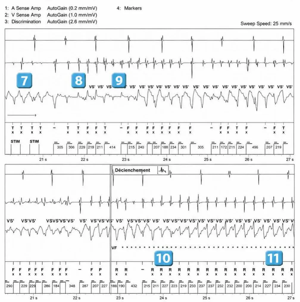 Abbott ICD electrogram, segment 4 of 6 — Redetection counter after acceleration of VT in the VF zone