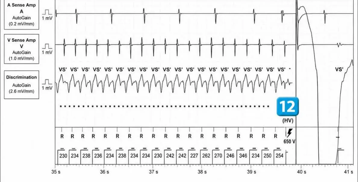 Abbott ICD electrogram, segment 5 of 6 — Redetection counter after acceleration of VT in the VF zone