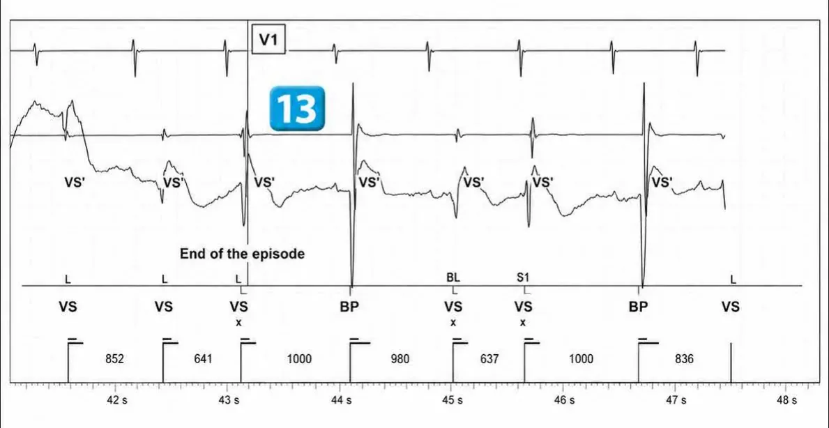 Abbott ICD electrogram, segment 6 of 6 — Redetection counter after acceleration of VT in the VF zone