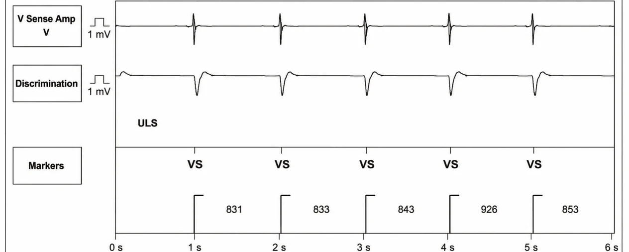Abbott ICD electrogram, segment 1 of 4 — New recommendations and number cycles in initial detection