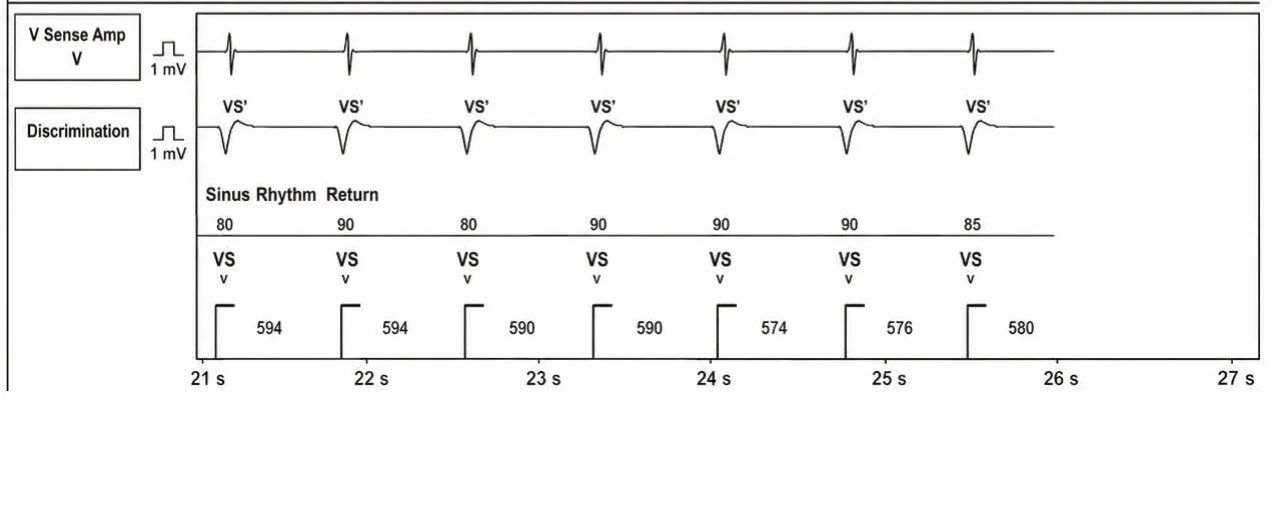 Abbott ICD electrogram, segment 4 of 4 — New recommendations and number cycles in initial detection