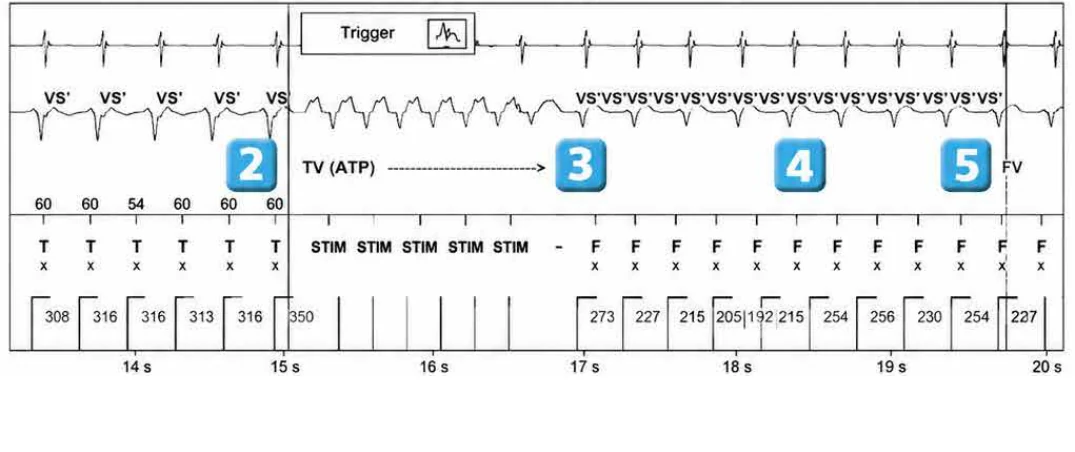 Abbott ICD electrogram, segment 3 of 5 — New recommendations and number cycles in initial detection