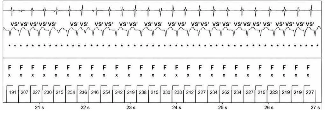 Abbott ICD electrogram, segment 4 of 5 — New recommendations and number cycles in initial detection
