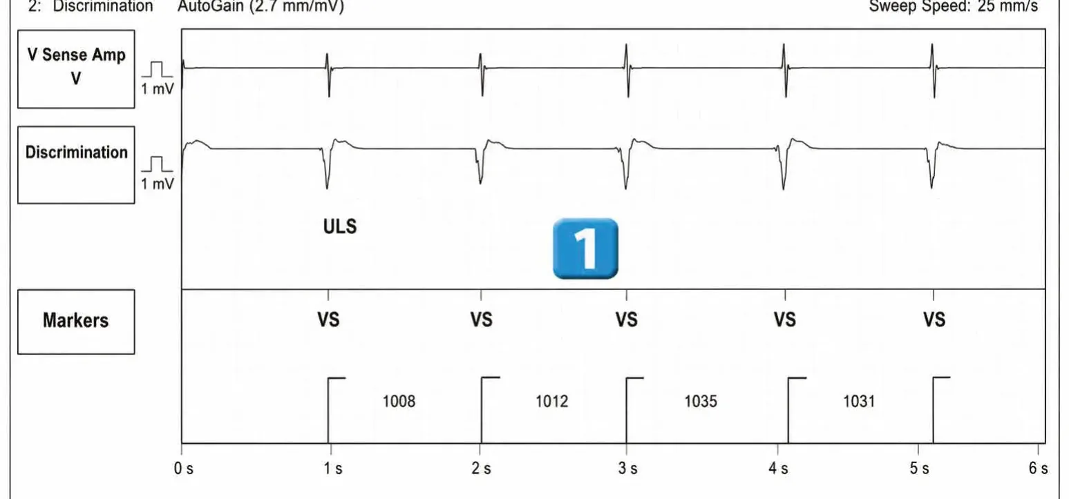 Abbott ICD electrogram, segment 1 of 3 — New recommandations and number cycles in initial detection