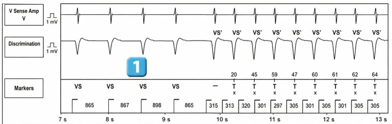 Abbott ICD electrogram, segment 1 of 2 — New recommandations and number cycles in initial detection