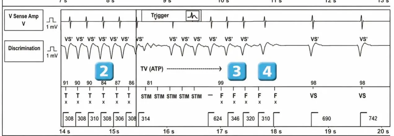 Abbott ICD electrogram, segment 2 of 2 — New recommandations and number cycles in initial detection