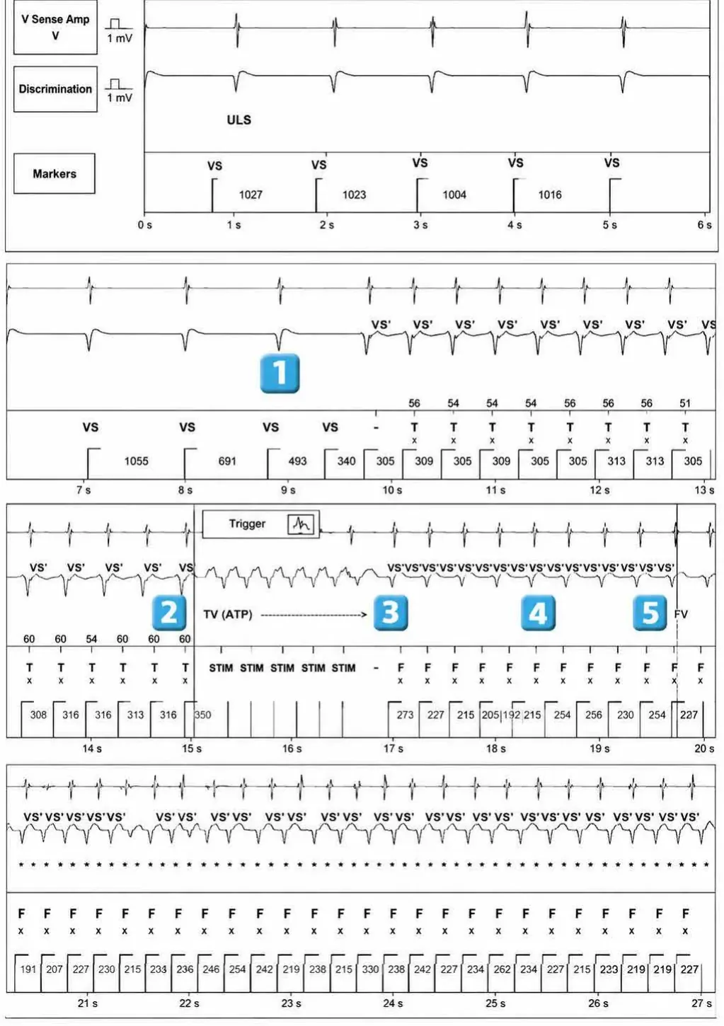 Abbott ICD electrogram, segment 1 of 2 — New recommandations and number cycles in initial detection