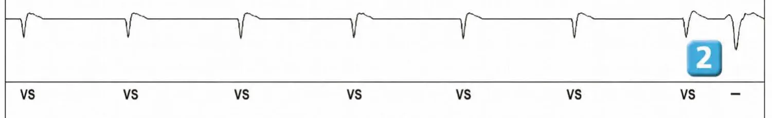 Abbott ICD electrogram, segment 2 of 3 — New recommandations and number cycles in initial detection