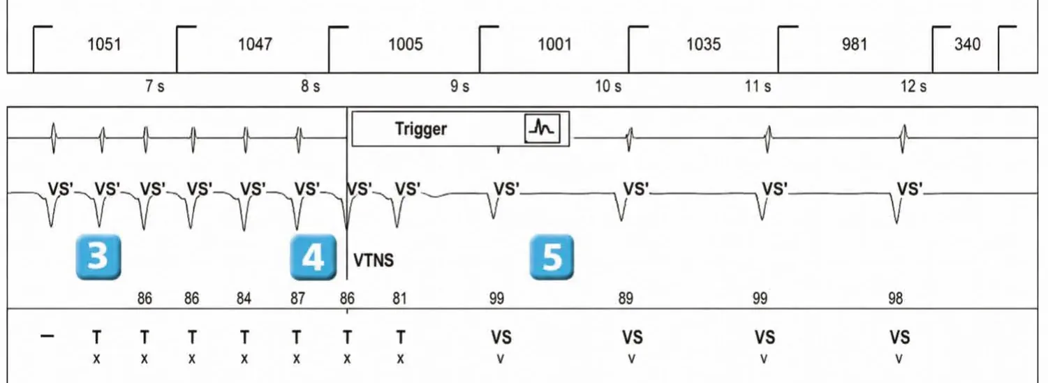 Abbott ICD electrogram, segment 3 of 3 — New recommandations and number cycles in initial detection