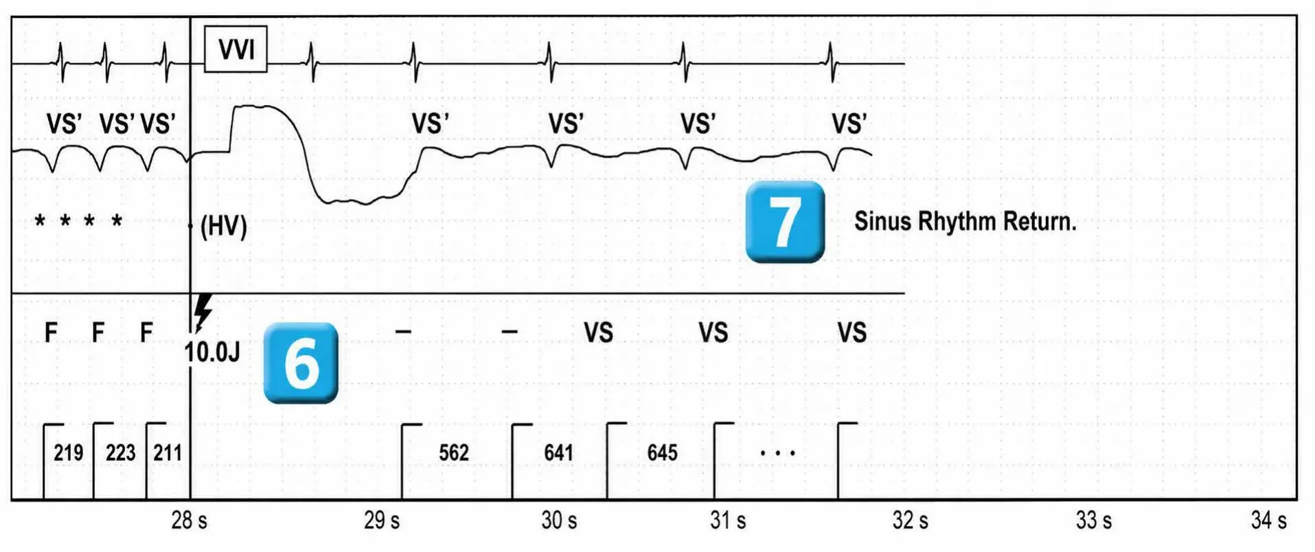 Abbott ICD electrogram, segment 2 of 2 — New recommandations and number cycles in initial detection