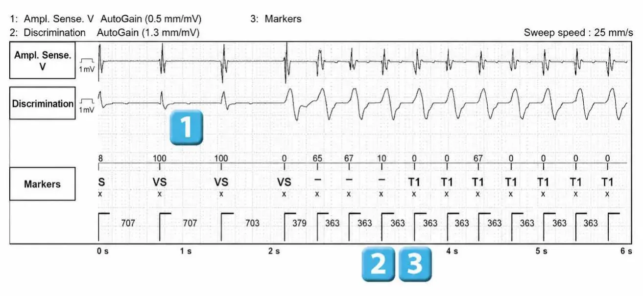 Abbott ICD electrogram, segment 1 of 2 — VT episode and single chamber discrimination