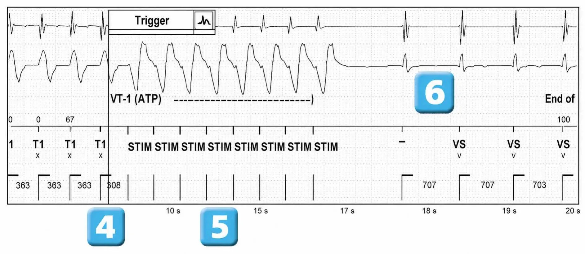 Abbott ICD electrogram, segment 2 of 2 — VT episode and single chamber discrimination