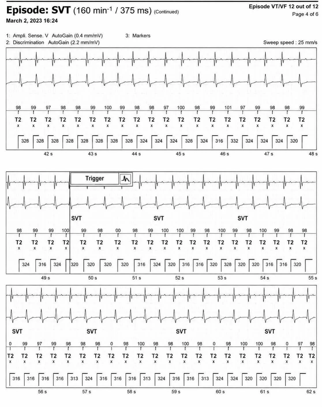 Episode of sinus tachycardia and single-chamber discrimination