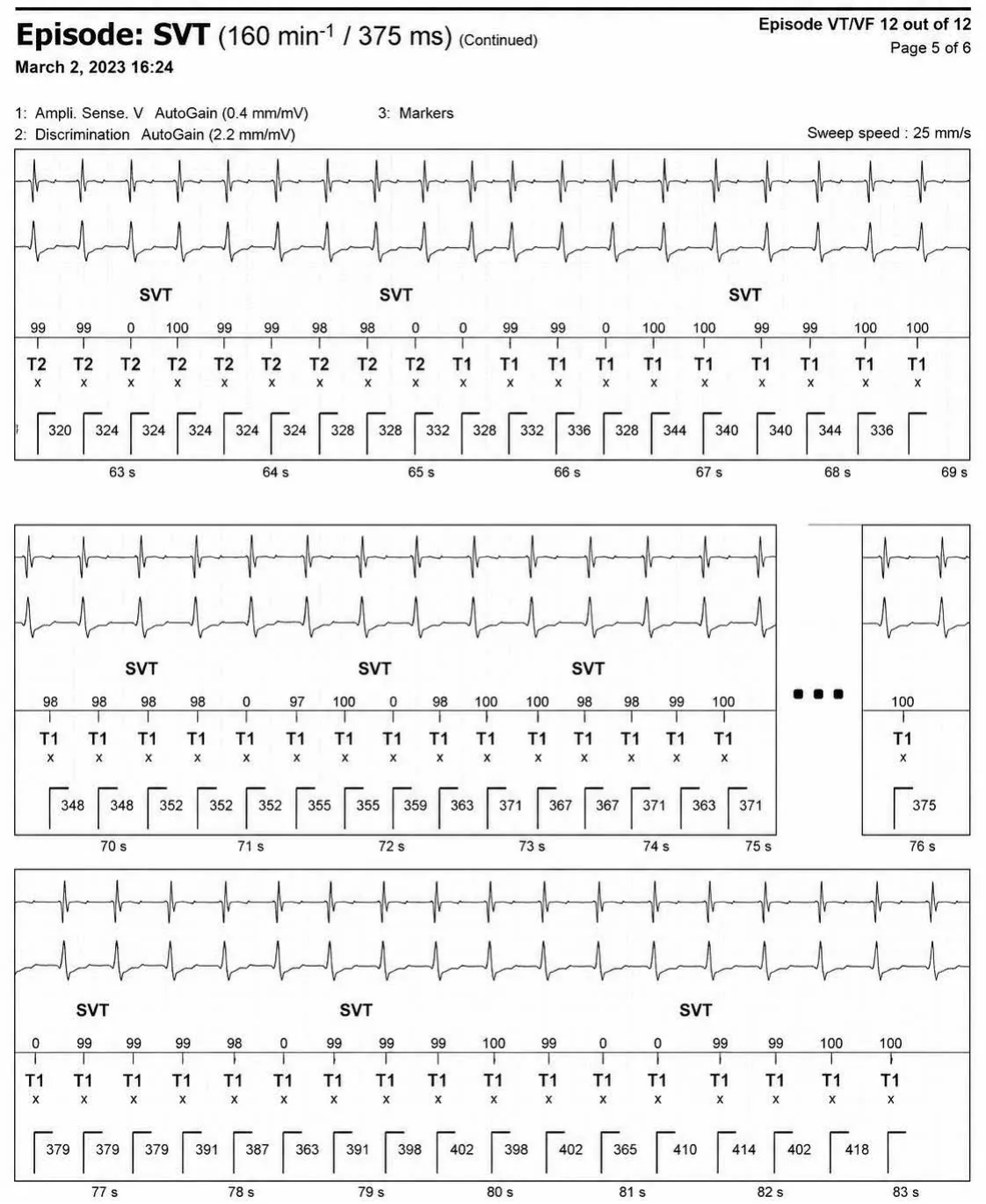 Episode of sinus tachycardia and single-chamber discrimination