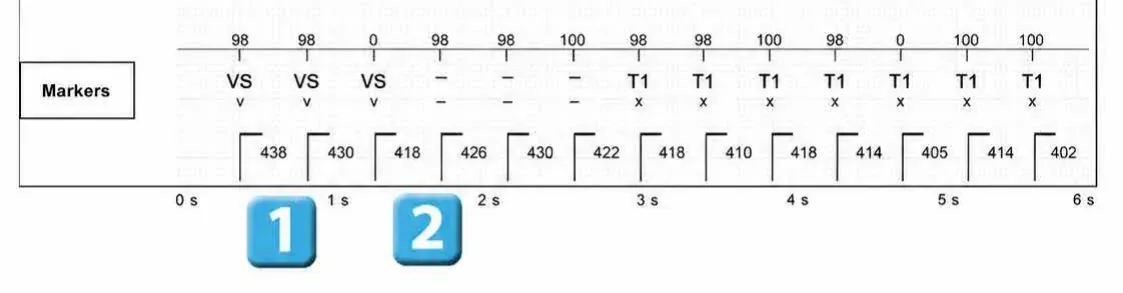Abbott ICD electrogram, segment 1 of 4 — Episode of sinus tachycardia and single-chamber discrimination