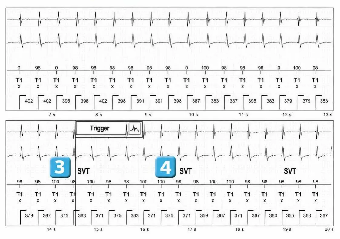 Abbott ICD electrogram, segment 2 of 4 — Episode of sinus tachycardia and single-chamber discrimination