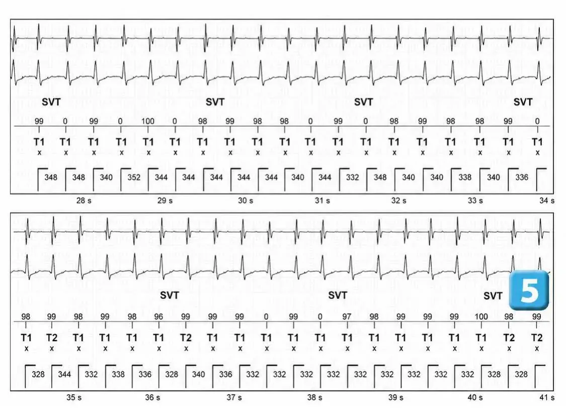 Abbott ICD electrogram, segment 3 of 4 — Episode of sinus tachycardia and single-chamber discrimination