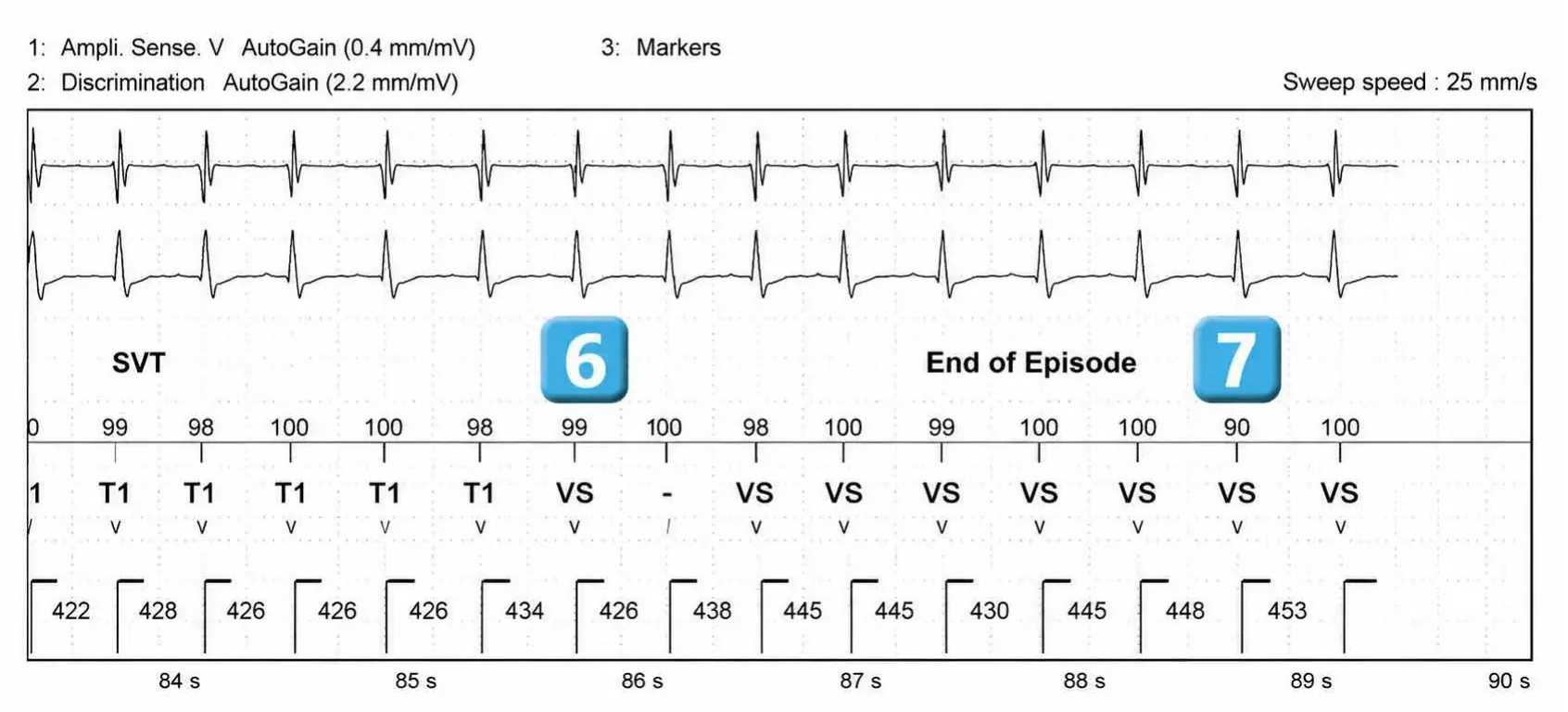 Abbott ICD electrogram, segment 4 of 4 — Episode of sinus tachycardia and single-chamber discrimination