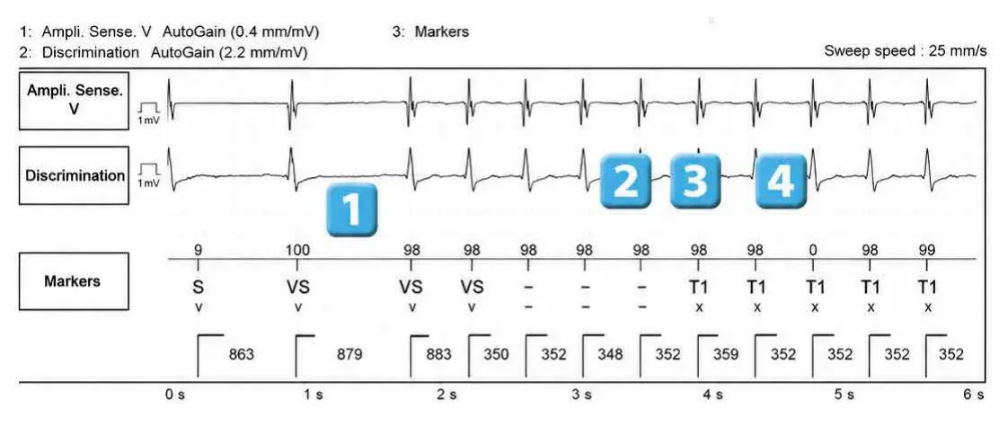 Abbott ICD electrogram, segment 1 of 3 — Atrial tachycardia and single-chamber discrimination
