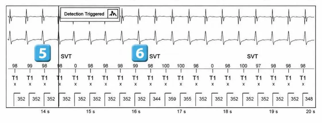 Abbott ICD electrogram, segment 2 of 3 — Atrial tachycardia and single-chamber discrimination