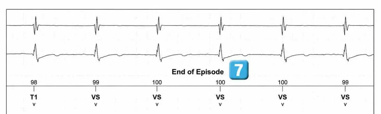 Abbott ICD electrogram, segment 3 of 3 — Atrial tachycardia and single-chamber discrimination