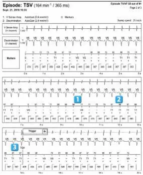Abbott ICD electrogram, segment 1 of 3 — Simple chamber discrimination and discriminant association