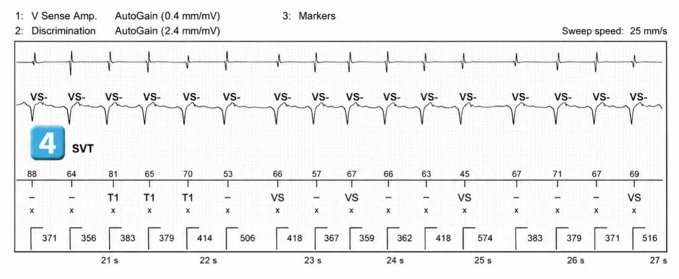 Abbott ICD electrogram, segment 2 of 3 — Simple chamber discrimination and discriminant association
