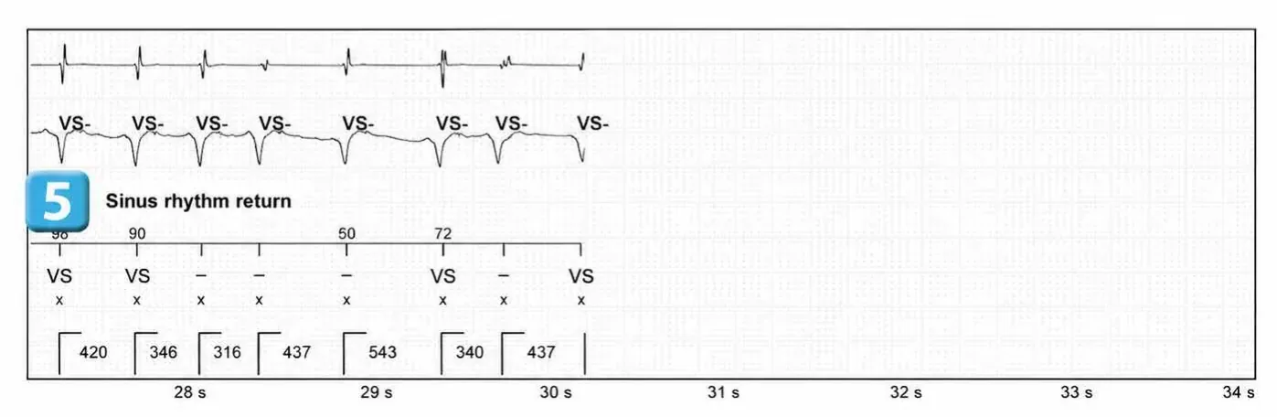 Abbott ICD electrogram, segment 3 of 3 — Simple chamber discrimination and discriminant association