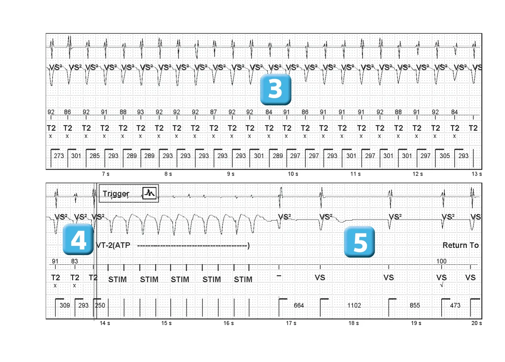 Abbott ICD electrogram, segment 2 of 2 — Single-chamber discrimination and optimization of the criterion based on morphology