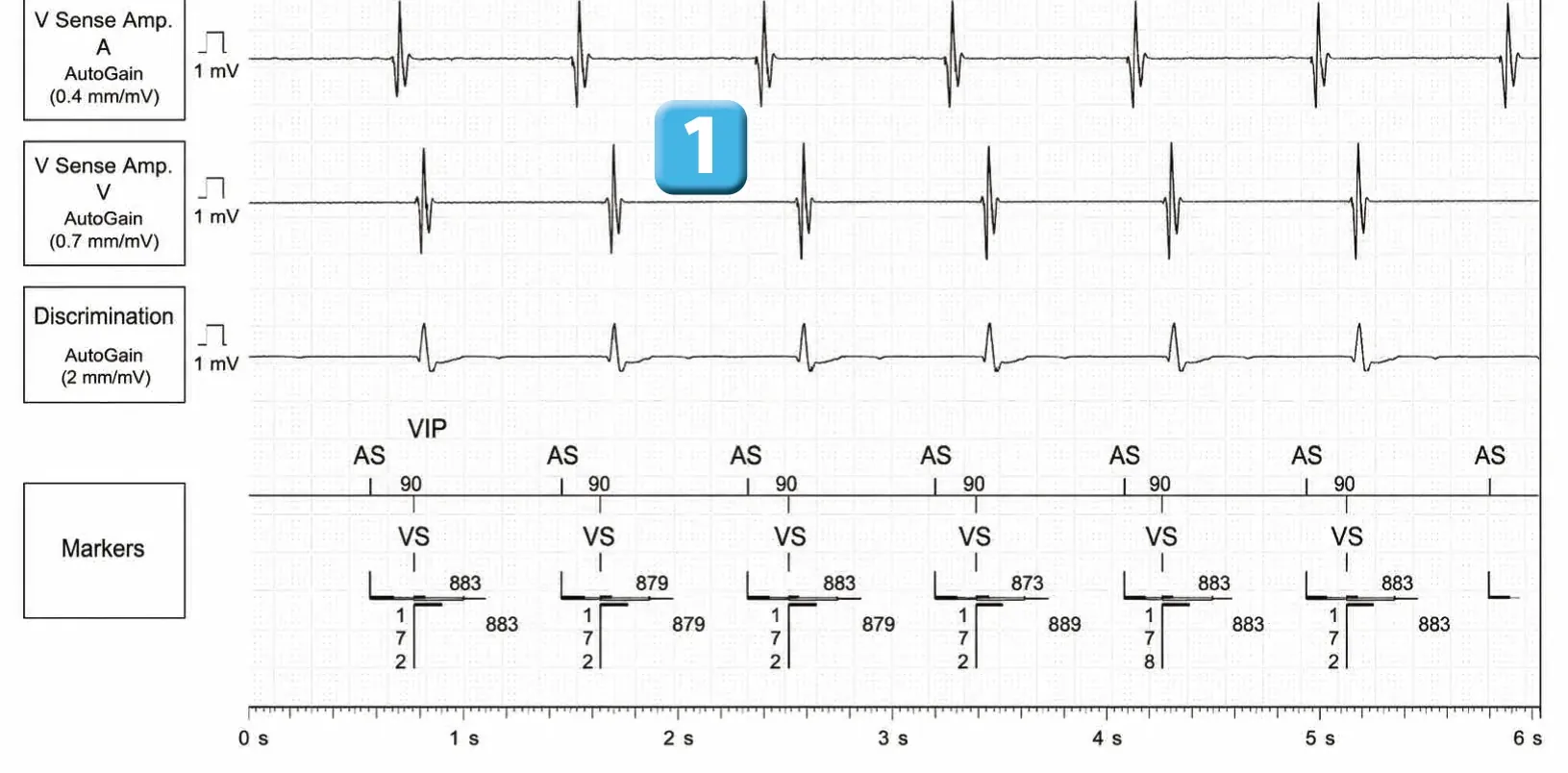 Abbott ICD electrogram, segment 1 of 3 — Discrimination between double chamber and branch V > A