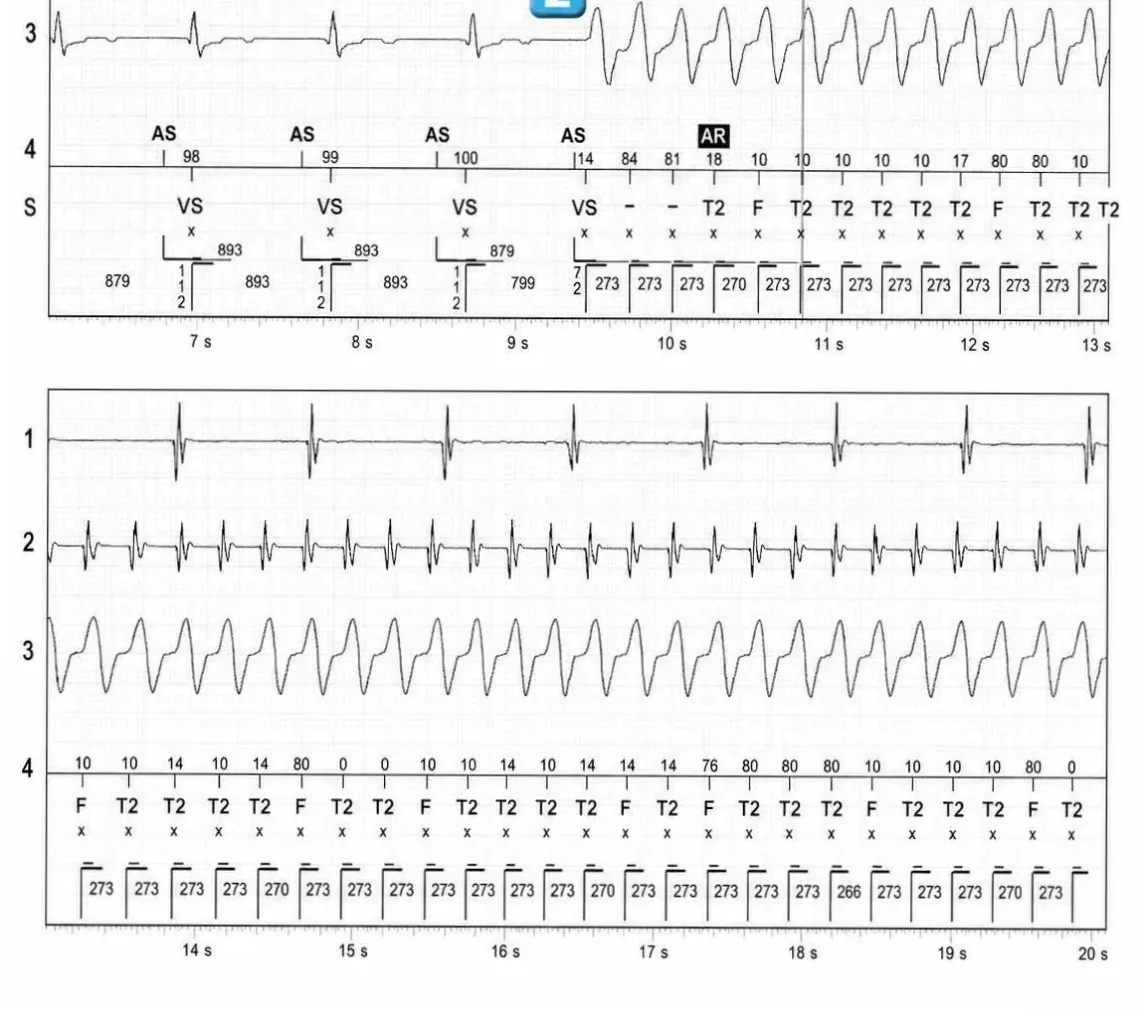 Abbott ICD electrogram, segment 2 of 3 — Discrimination between double chamber and branch V > A