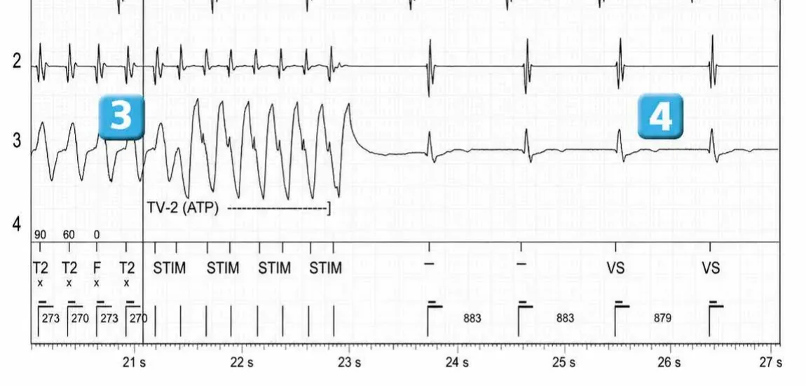Abbott ICD electrogram, segment 3 of 3 — Discrimination between double chamber and branch V > A