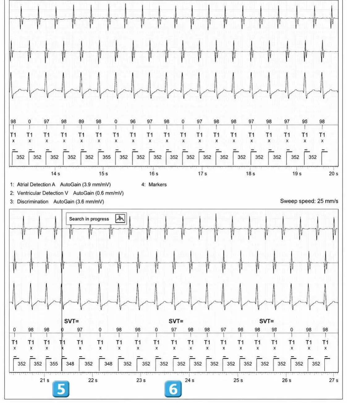 Double chamber and branch discrimination V = A