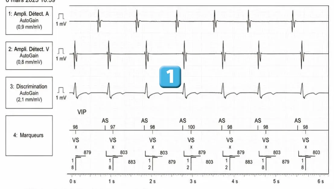 Abbott ICD electrogram, segment 1 of 3 — Double chamber and branch discrimination V = A