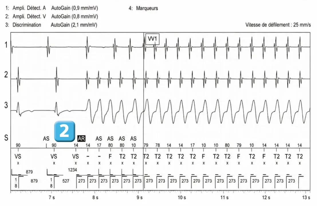 Abbott ICD electrogram, segment 2 of 3 — Double chamber and branch discrimination V = A