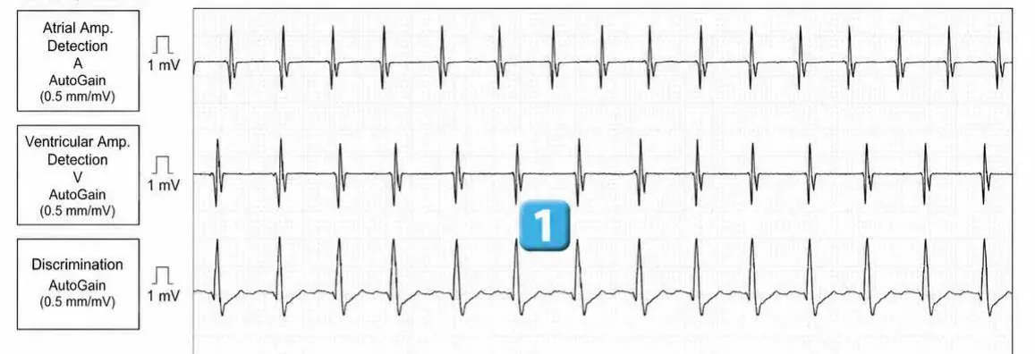 Abbott ICD electrogram, segment 1 of 5 — Double chamber and branch discrimination V = A
