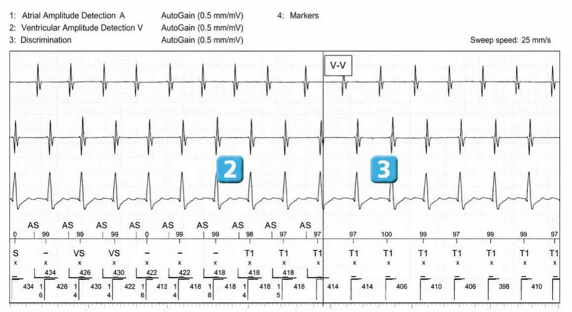 Abbott ICD electrogram, segment 2 of 5 — Double chamber and branch discrimination V = A