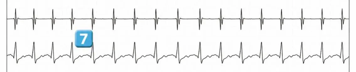 Abbott ICD electrogram, segment 1 of 4 — Double chamber and branch discrimination V = A