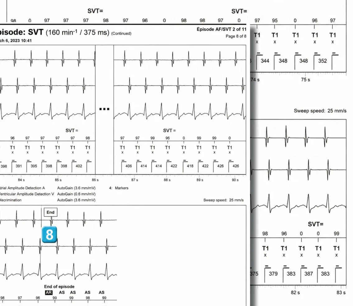 Abbott ICD electrogram, segment 2 of 4 — Double chamber and branch discrimination V = A
