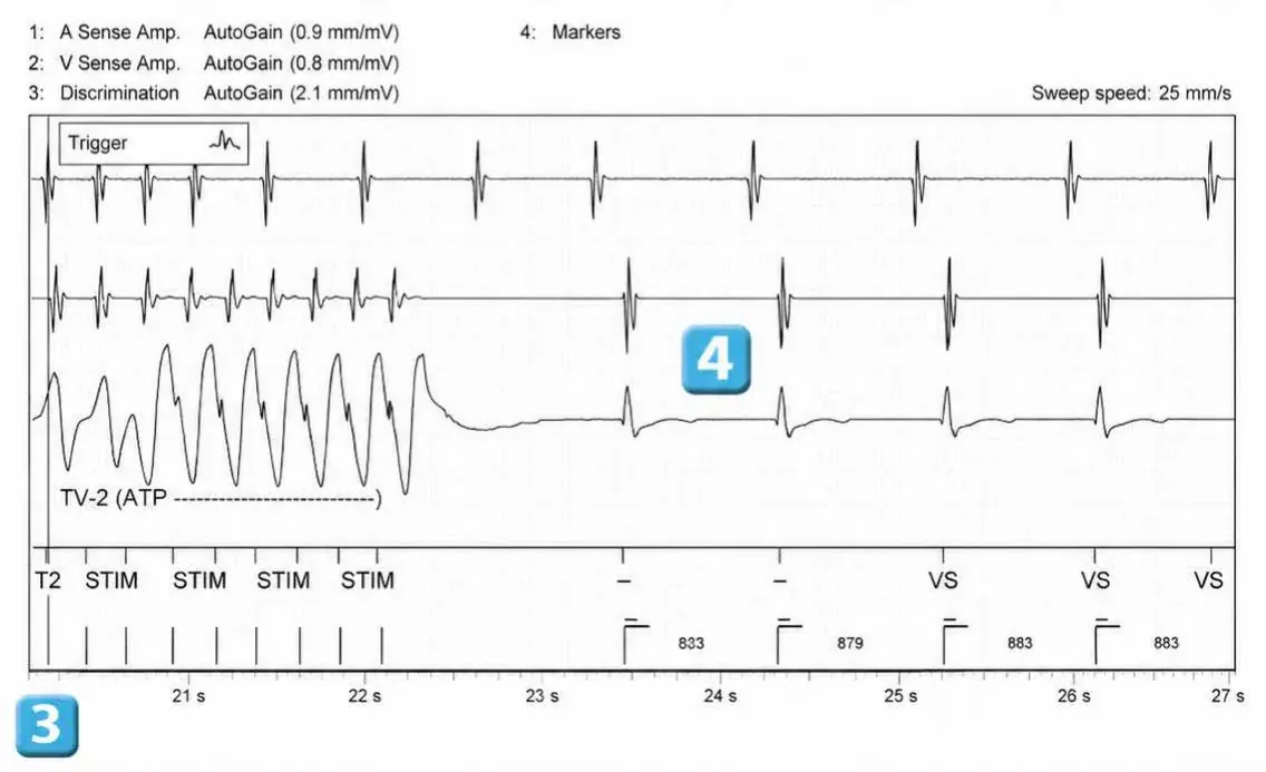Abbott ICD electrogram, segment 3 of 3 — Double chamber and branch discrimination V = A