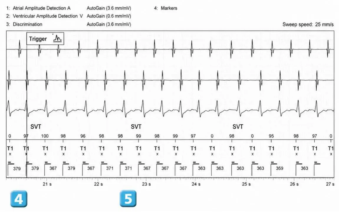 Abbott ICD electrogram, segment 3 of 5 — Double chamber and branch discrimination V = A