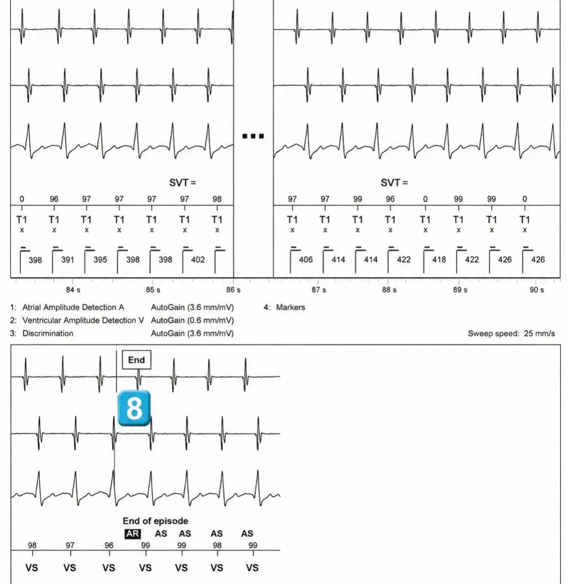 Abbott ICD electrogram, segment 3 of 4 — Double chamber and branch discrimination V = A