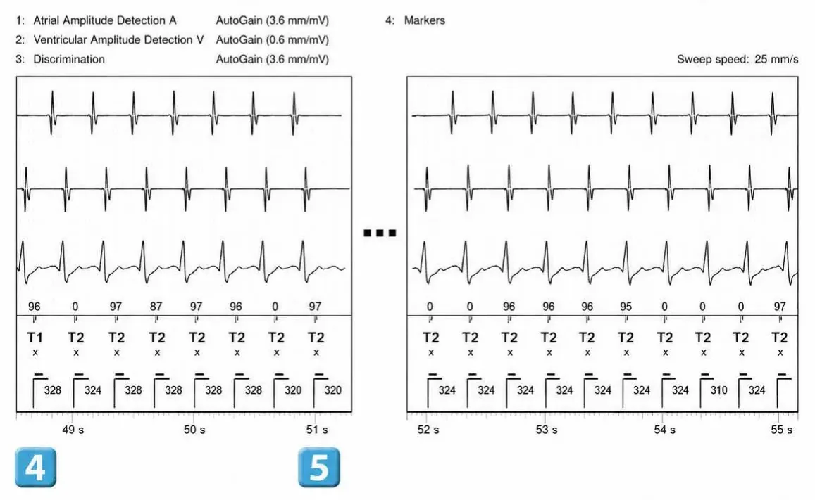 Abbott ICD electrogram, segment 4 of 5 — Double chamber and branch discrimination V = A
