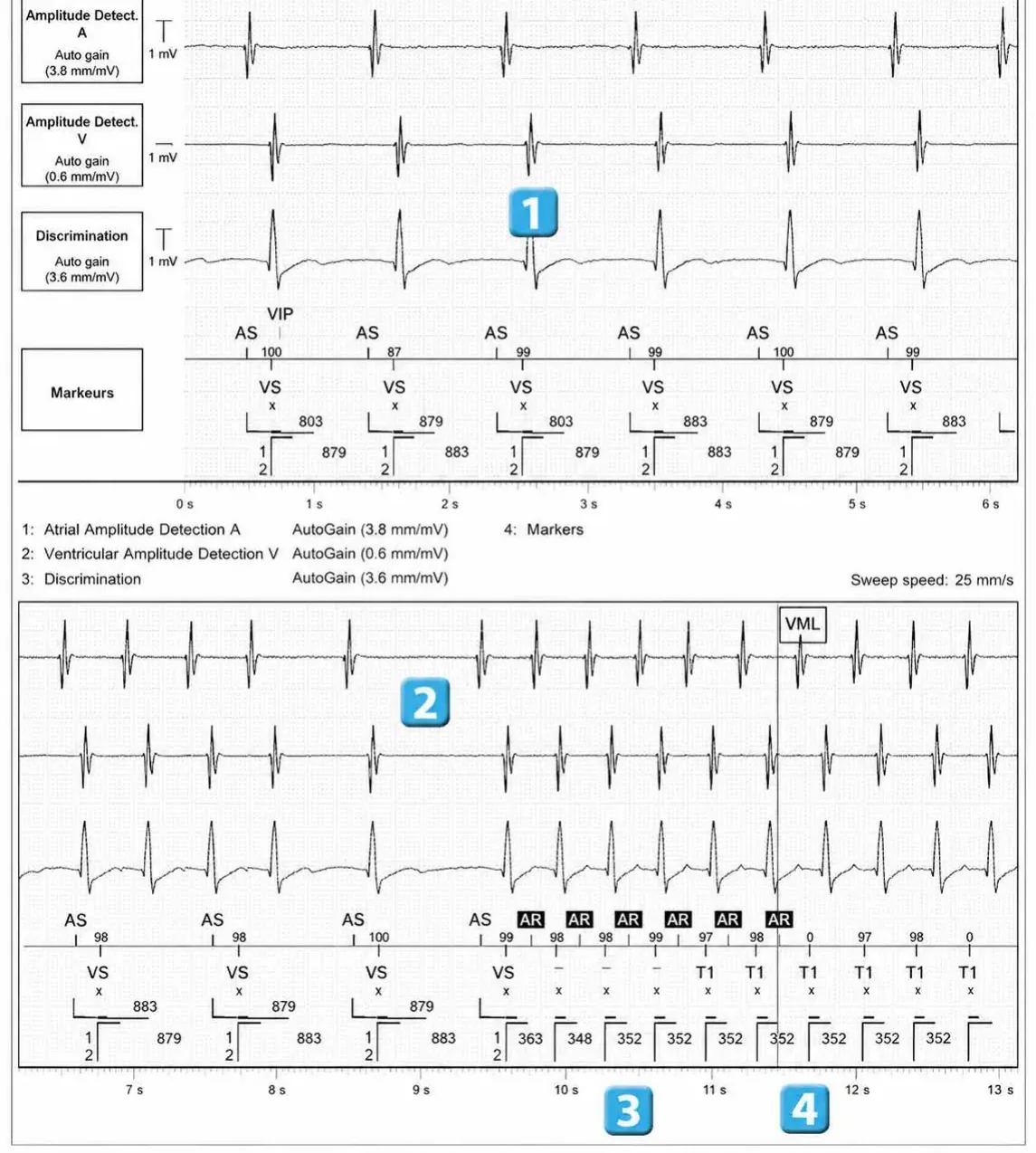Abbott ICD electrogram, segment 4 of 4 — Double chamber and branch discrimination V = A