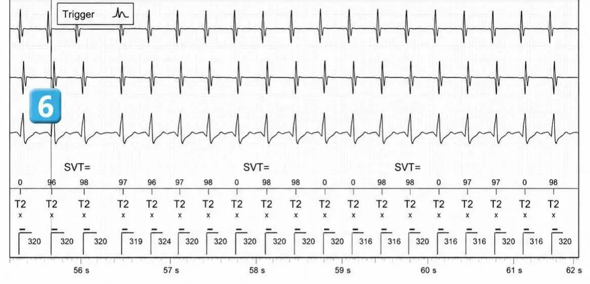 Abbott ICD electrogram, segment 5 of 5 — Double chamber and branch discrimination V = A