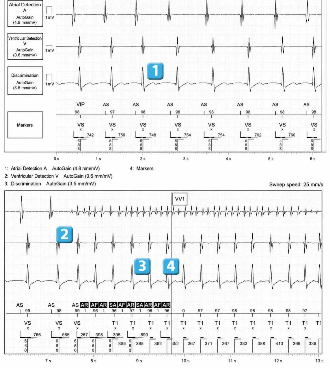 Abbott ICD electrogram, segment 1 of 3 — Dual chamber and V< A branch discrimination